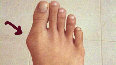 นิ้วหัวแม่เท้า เกเร