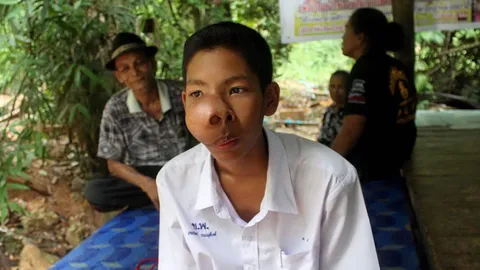 หมอติดภารกิจ เลื่อนผ่าจมูก 'น้องปั้น'