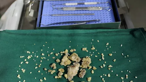 ตะลึง! หมอฟันอินเดียถอนฟันจากปากหนุ่มวัย 17 กว่า 200 ซี่