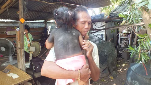 พบ ด.ญ.2 ขวบ มีขนเต็มตัวคล้ายมนุษย์วานร