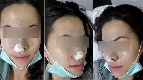 ปั้นดั้งให้สวย...งานศิลปะบนใบหน้า ศัลยกรรม…เปลี่ยนชีวิต