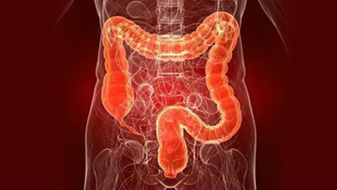 "ทาร์เก็ตเทด เธอราปี" นวัตกรรมยืดชีวิต...ผู้ป่วยมะเร็งลำไส้ใหญ่