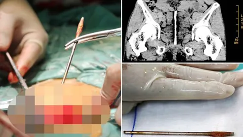 หวิดดับ!! หนุ่มใหญ่จีนใส่แท่งเหล็กค้ำจู๋  แต่ดันหลุดทิ่มกระเพาะปัสสาวะ