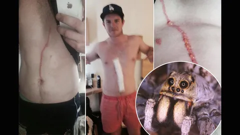 สะดุ้งเฮือก!! แมงมุมฝังตัวใต้ผิวหนังหนุ่มออสซี่