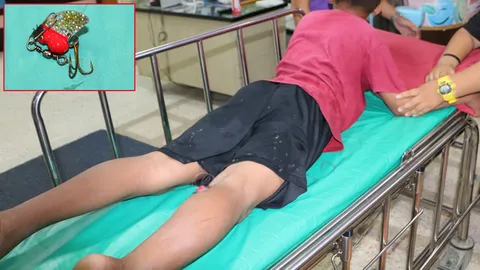 เตือนภัยเบ็ดเกี่ยวขา หนูน้อย 10 ขวบ โร่หาหมอ