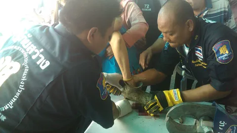 สยอง! สาวใหญ่โชคร้ายถูกเครื่องบดขยี้มือเละ