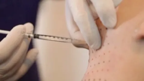 ทำสารฆ่าไขมัน แก้คางอูม 2 ชั้น