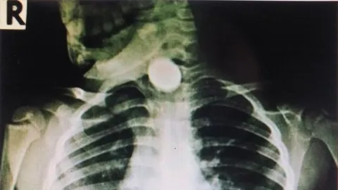 หามส่ง รพ.! เด็กสองขวบเผลอกลืนเหรียญบาท