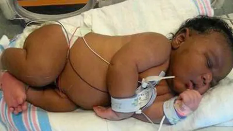 ทารก​ยักษ์​น้ำหนัก 6.4 กก.