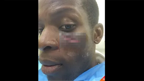 'ไรท์จิ๋ว' โพสต์ภาพแผลแตกใต้ตา 'โอนูโอฮา' เกมพ่ายปืน