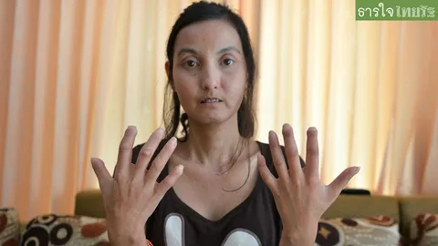 อดีตพริตตี้ ป่วยโรคแปลก ‘หนังแข็ง’  ชีวิตรันทด วอนขอความช่วยเหลือ!   