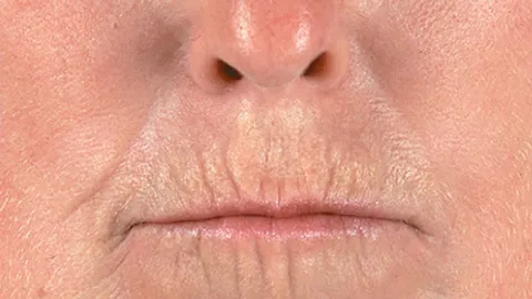 "แผลปลายนิ้ว-มือชา-อ้าปากไม่ได้" สัญญาณเตือน...โรคผิวหนังแข็ง