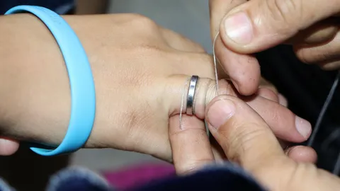 สาววัย17 ร้องกู้ภัยฯช่วย! แหวนติดนิ้วเอาไม่ออก