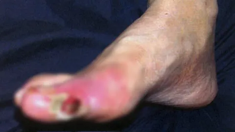 ยาวิเศษรักษาแผลเบาหวาน