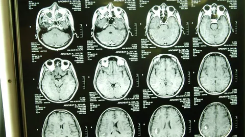 เชื้อแบคทีเรียเข้าสมองและก่อโรคได้อย่างไร?