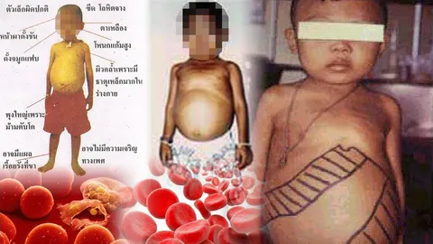 ตรวจสารพันธุกรรมในเลือด "แม่" ค้นหา "ยีน" ธาลัสซีเมียทารกในครรภ์