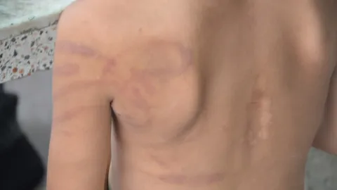 ชาวบ้านปทุมฯ สุดทน พบด.ช.วัย 6 ขวบ ถูกแม่เลี้ยงใช้สายไฟ-ไม้กวาดไล่ตี 