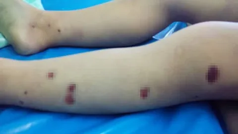 ดับปริศนา! ด.ช. 3 ปีป่วยมะเร็งเม็ดเลือด พบรอยช้ำบนตัวหลายจุด