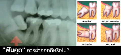 "ฟันคุด" ควรผ่าออกดีหรือไม่?
