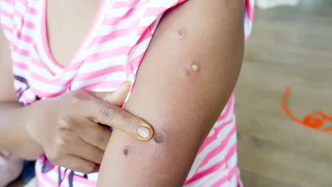 สาวสยอง เจอแมลงฝังในร่างกาย! กลัวเป็นตัวร้ายแพร่เชื้อ-ขยายพันธุ์