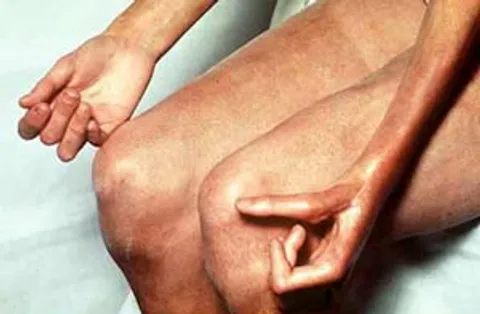 โรคหนังแข็ง (scleroderma) 