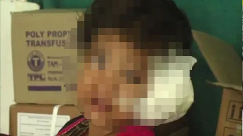 หมออินเดียผงะ ดึงหนอน 80 ตัวออกจากหูเด็กหญิง 4 ขวบ ปวดมากจนต้องมา รพ.