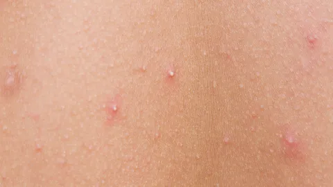 หยุดสิวหรือตุ่มแดงที่ก้น ด้วยวิธีป้องกันที่ง่ายดาย