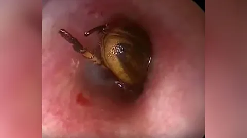 ฮาไม่ออก แมลงสาบเข้าหู สุดรำคาญ ชาวจีนจนปัญญา ฉีดยาฆ่าแมลงกรอกหู