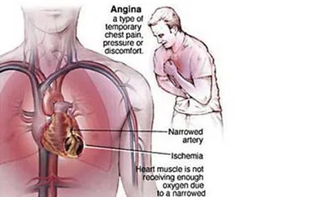 คนเตี้ยเสียวโรคหัวใจสูง ไม่ต้องเป็นทุกข์เพราะยังมีปัจจัยเสี่ยงอื่น