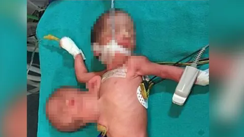 แพทย์ในอินเดียผ่าตัดช่วยทารกสองหัว