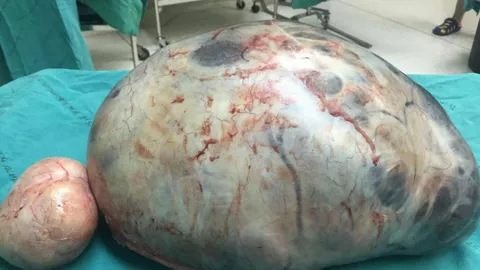 ตกใจนึกว่าลงพุง! หมอผงะ ผ่าเนื้องอกรังไข่หญิงลาว ใหญ่มหึมาหนัก 8 กิโล (คลิป)