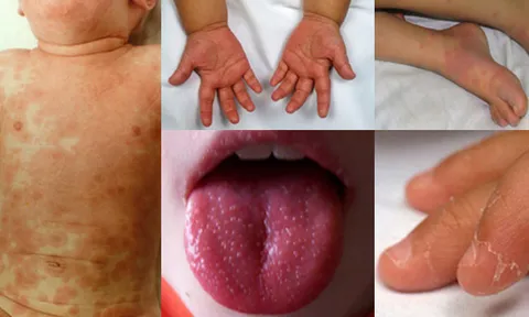 "คาวาซากิ" โรคร้ายคุกคามเด็ก!