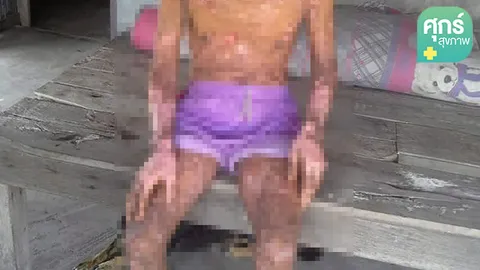 รู้จัก “โรคสะเก็ดเงิน”