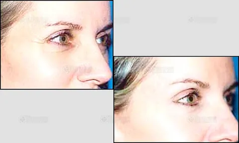 ฉีดอัดก๊าซคาร์บอน ลบรอยตีนกา หนุนผิวหน้าให้กลับเต่งตึง