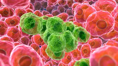 รพ.แห่ซื้อเครื่องรักษามะเร็ง รองรับผู้ป่วยเพิ่มขึ้นต่อเนื่อง