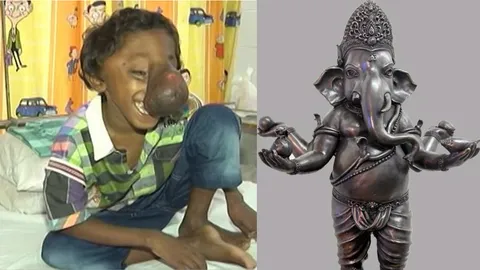 เร่งช่วยเด็กชายป่วยจมูกโตผิดปกติ คนอินเดีย เชื่อ พระพิฆเนศกลับชาติมาเกิด (ชมคลิป) 