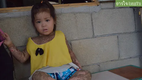 วอนช่วยเด็ก 3 ขวบ เป็นโรคดักแด้ ทรมานแสบคันทั้งตัว ไร้เงินรักษา