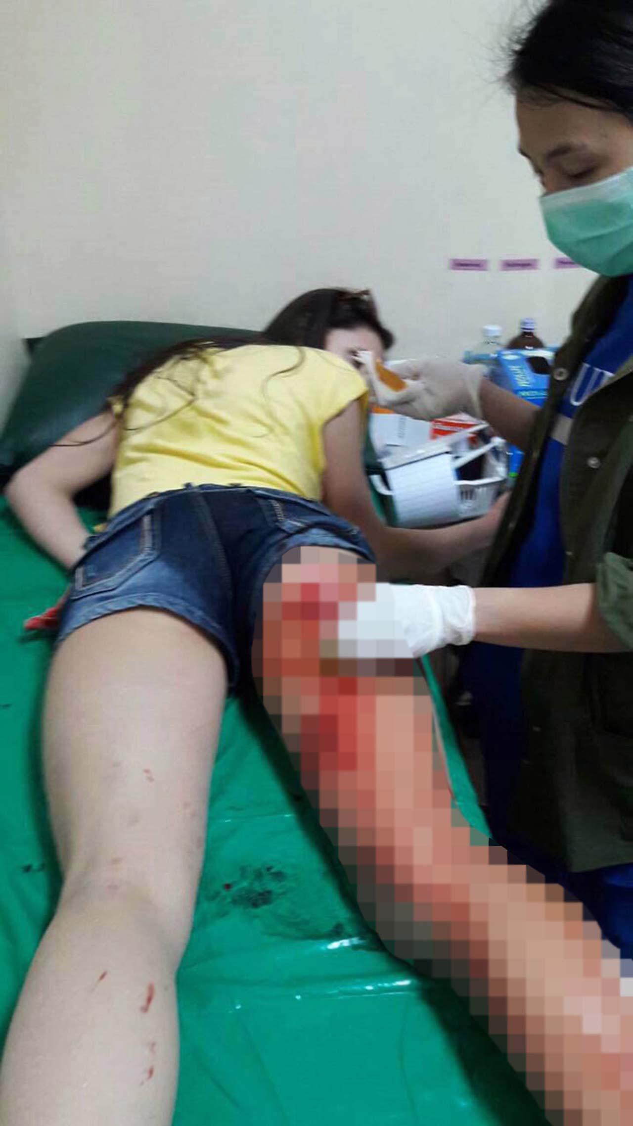 นักท่องเที่ยวสาวถูกลิงกัดมีบาดแผลฉีกขาดที่ด้านหลังต้นขาขวา