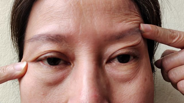 รู้ทันภาวะ “หนังตาตก” มีกี่สาเหตุ ก่อนตัดสินใจรักษา