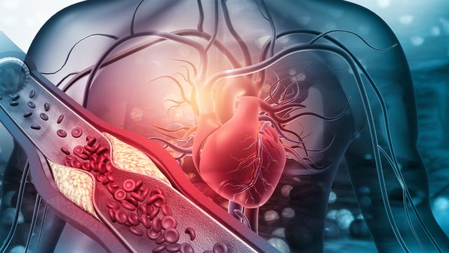 ยาลดไขมันในคนสมองเสื่อมไม่มีประโยชน์ เส้นเลือดหัวใจสมองตันเพิ่ม