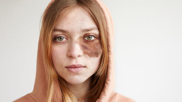 "ปานแดง-ปานดำ" แต่กำเนิด เรื่องจริงที่มากกว่าความสวยงาม เสี่ยง "ต้อหิน" ถึงขั้นตาบอด