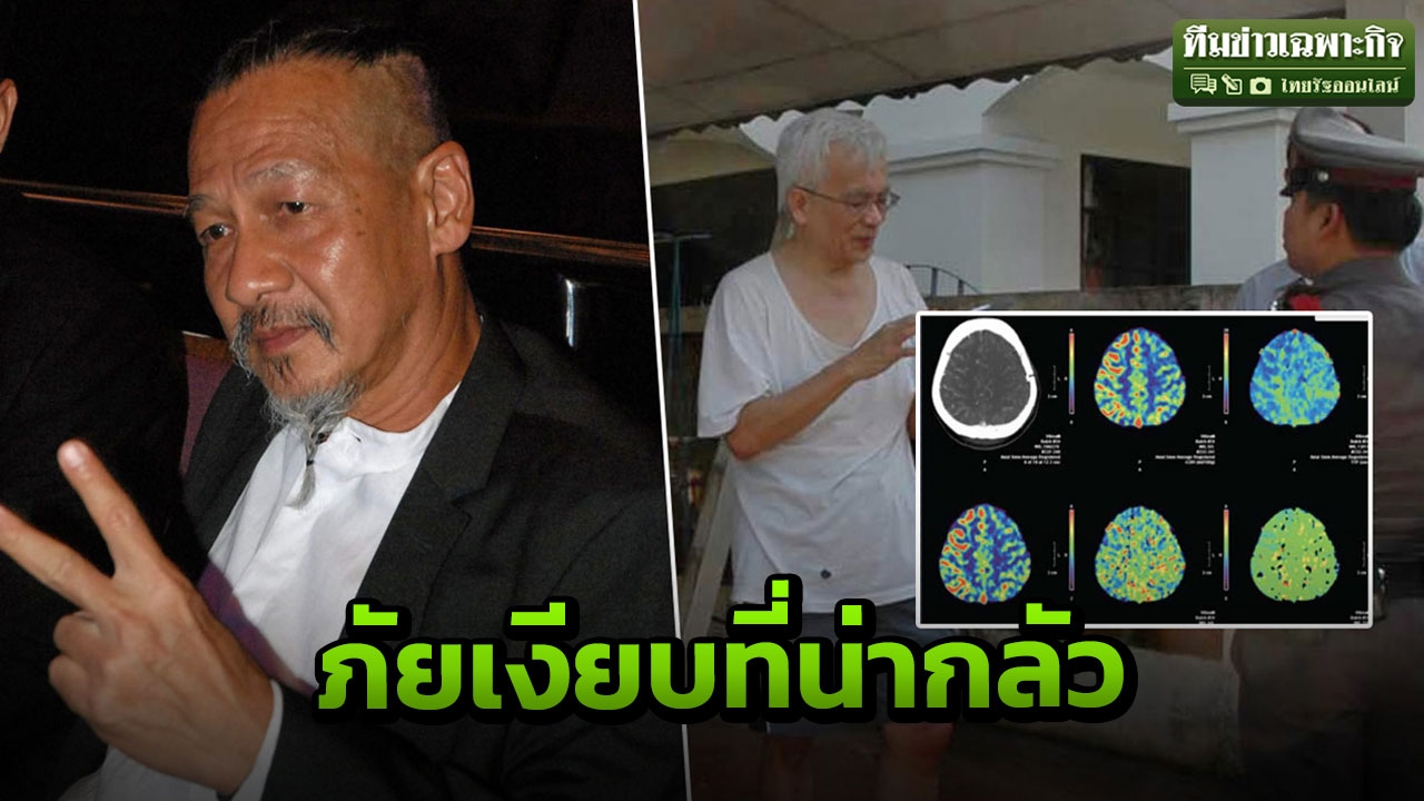 รู้จักโรคเส้นเลือดสมองตีบ แตก ซีกซ้าย-ขวาต่างกัน ถึงตาย พิการ พูดไม่ได้