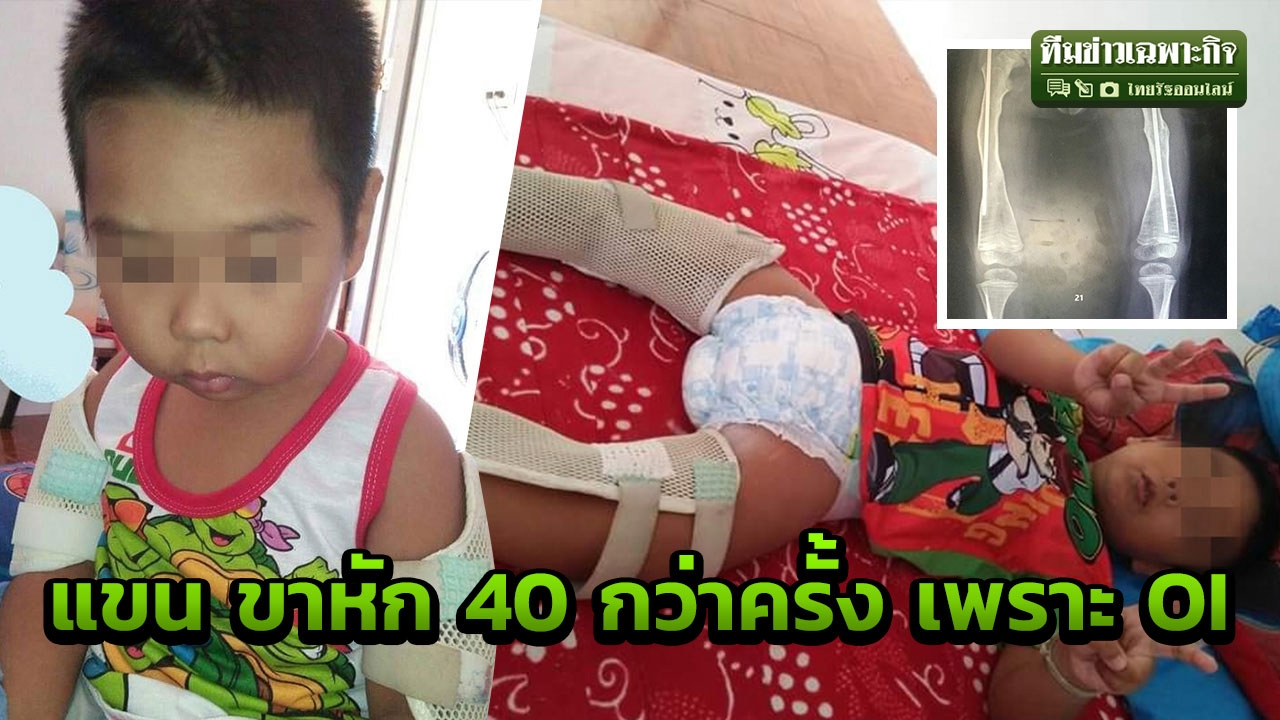 แขน ขาหักกว่า 40 ครั้ง! 5 ขวบ ป่วย OI โรคไม่มีวันหาย ไร้อาการเตือน (คลิป)