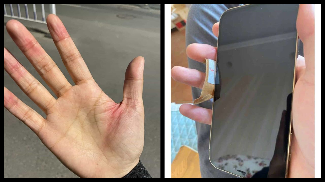 ภาพรอยแผลของผู้ใช้งาน iPhone 12 ที่อ้างว่าบาดมือ