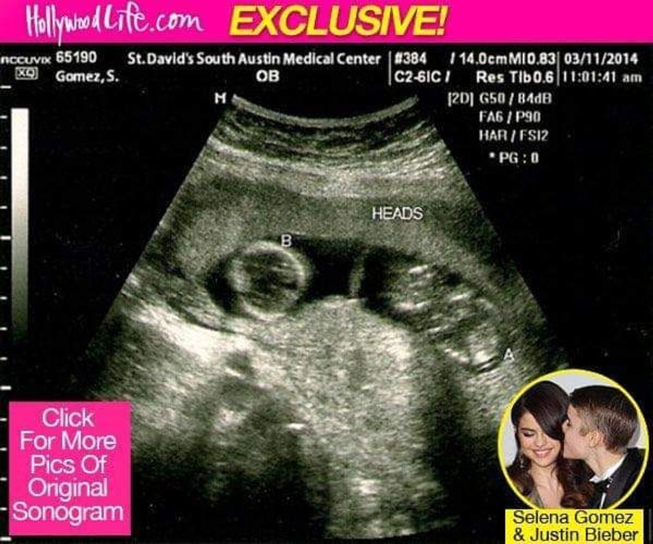 ภาพอัลตราซาวนด์ที่ปรากฏในข่าวลือของเซเลน่า โกเมซ ที่ภายหลังมีการเปิดเผยว่าเป็นของปลอม
