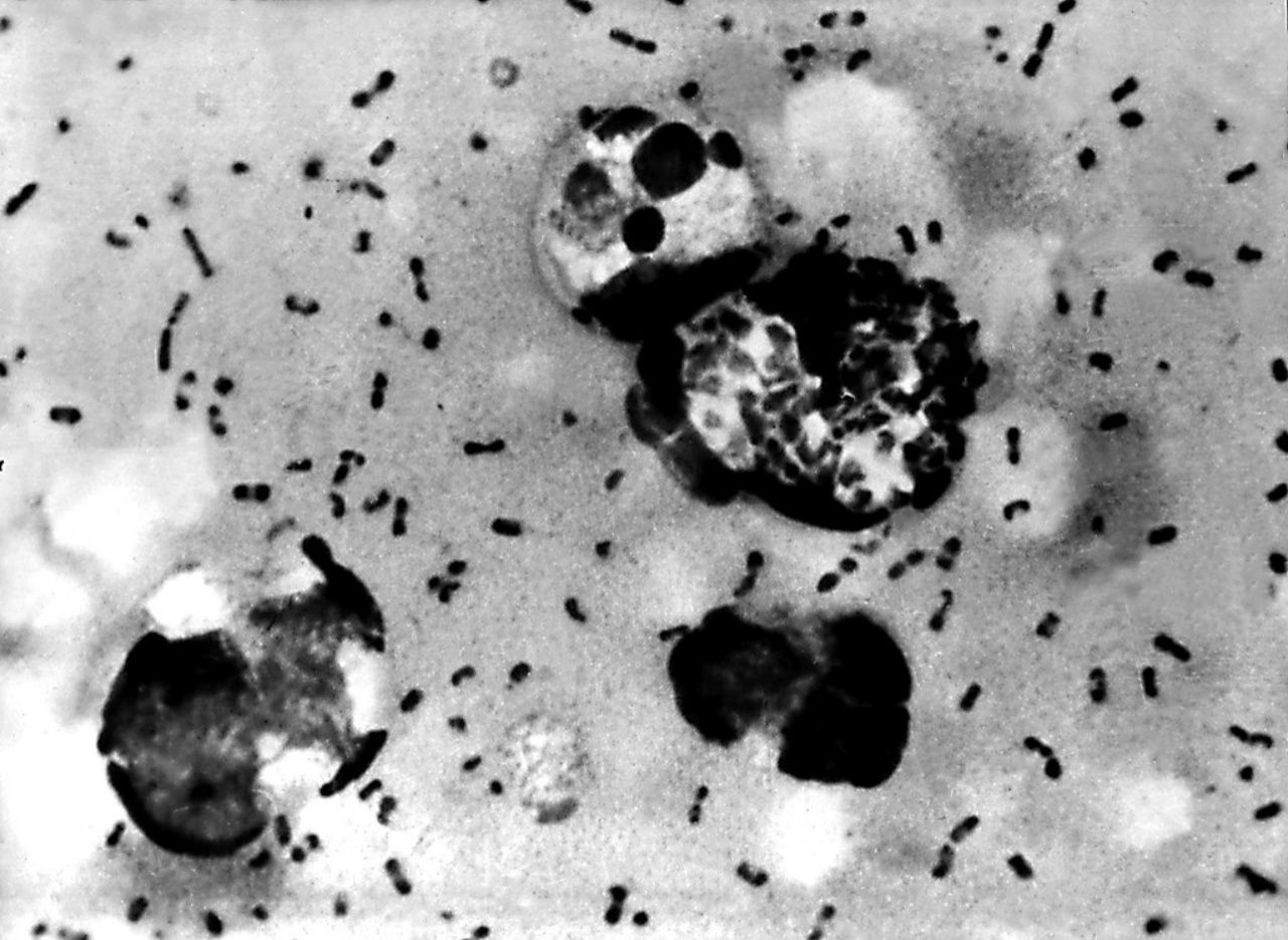 เชื้อแบคทีเรีย Yersinia Pestis สาเหตุทำให้เกิดโรคกาฬโรคต่อมน้ำเหลือง