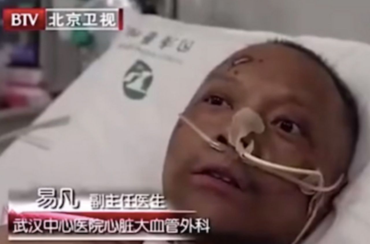 ดร.หยี ฟ่าน นายแพทย์ประจำโรงพยาบาลอู่ฮั่นอีกคนหนึ่งที่ติดเชื้อโควิด-19 และมีอาการผิวเปลี่ยนสีเช่นกัน แต่ได้รับการรักษาหาย ออกจากโรงพยาบาลได้แล้ว