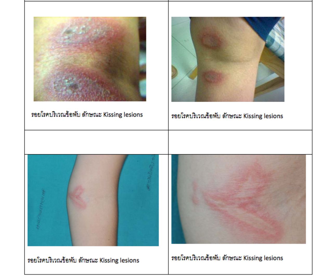 ภาพอธิบายตัวอย่างรอยโรค จาก พญ.มิ่งขวัญ วิชัยดิษฐ ผอ.สถาบันโรคผิวหนัง