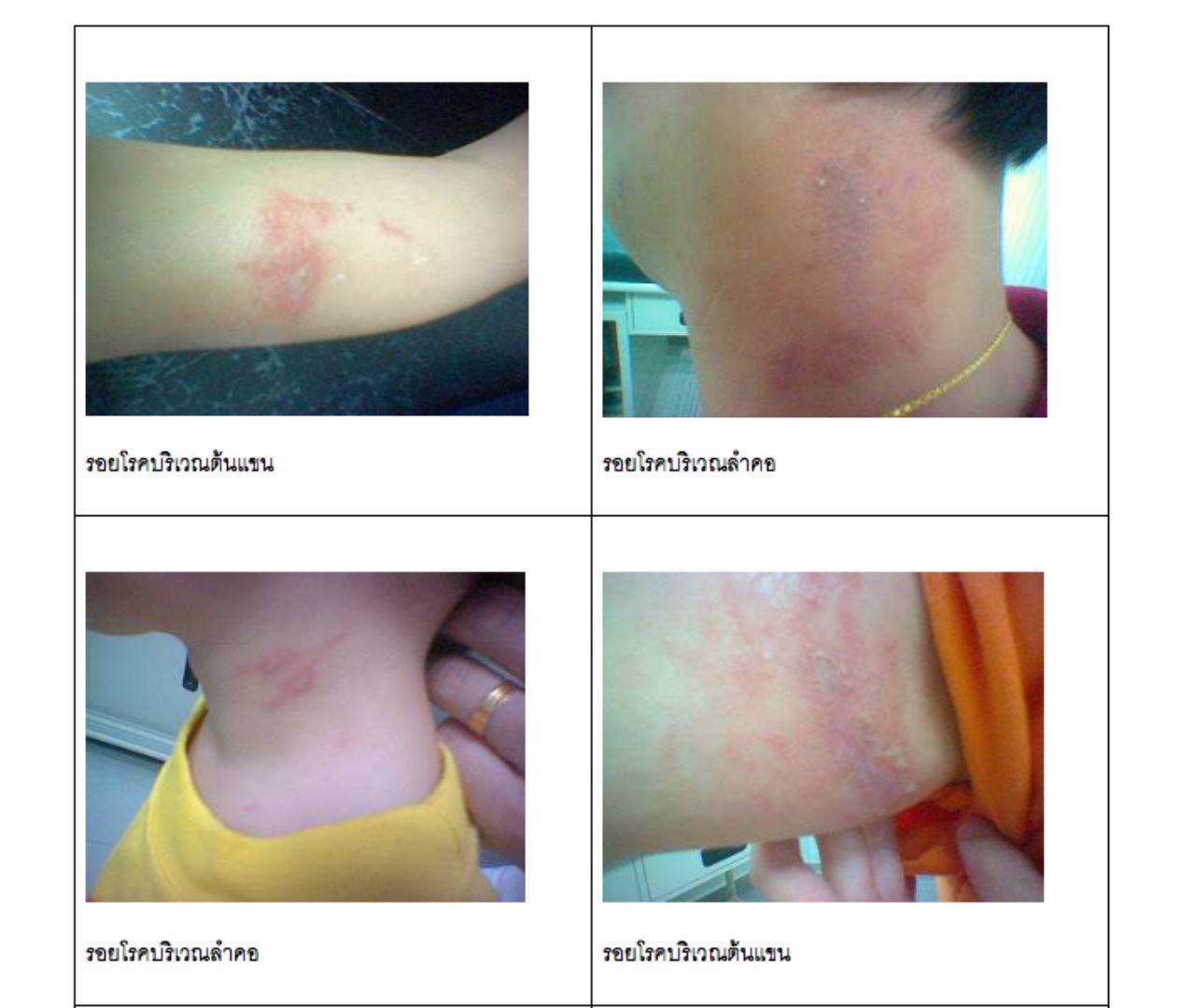 ภาพอธิบายตัวอย่างรอยโรค จาก พญ.มิ่งขวัญ วิชัยดิษฐ ผอ.สถาบันโรคผิวหนัง