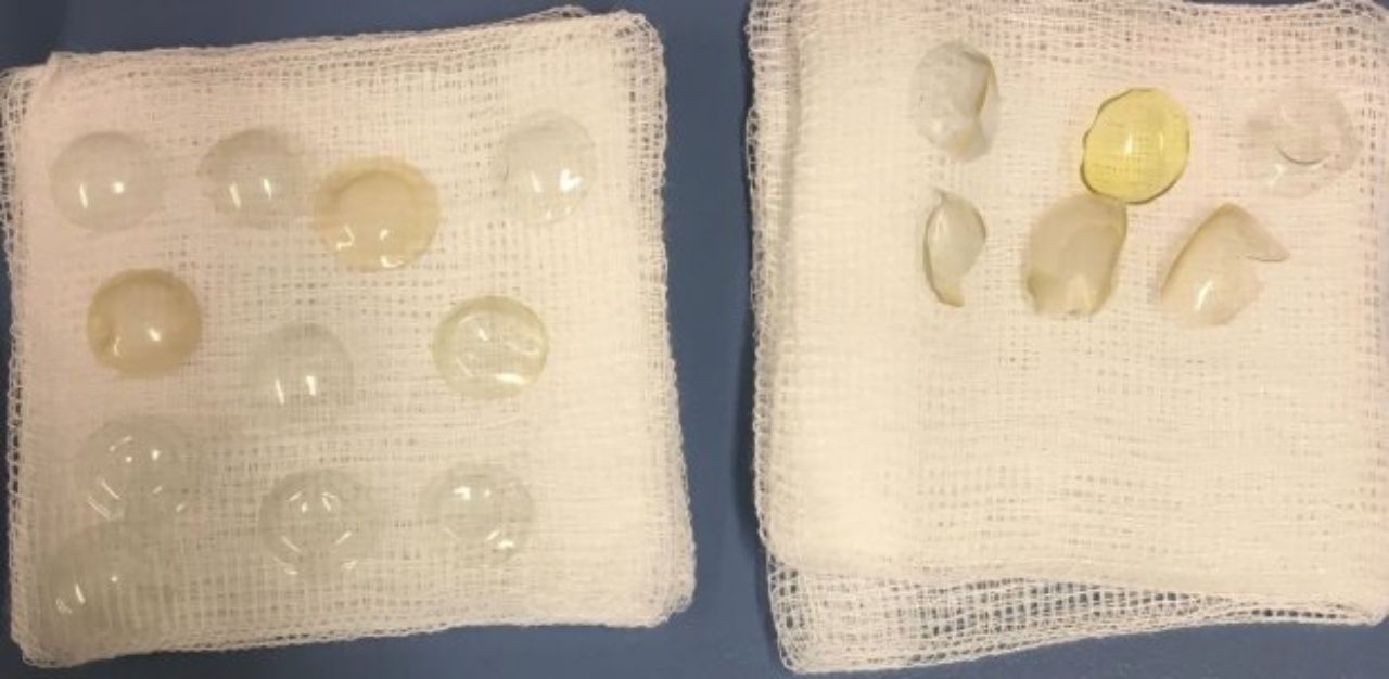 คอนแทคเลนส์ติดในดวงตาอื้อ